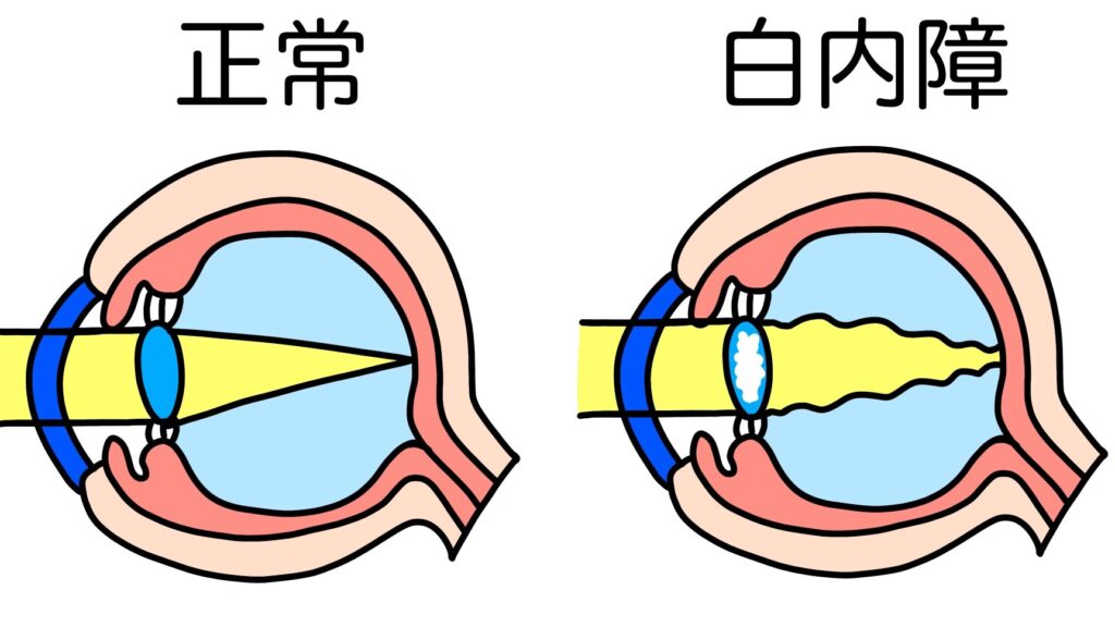 白内障イラスト