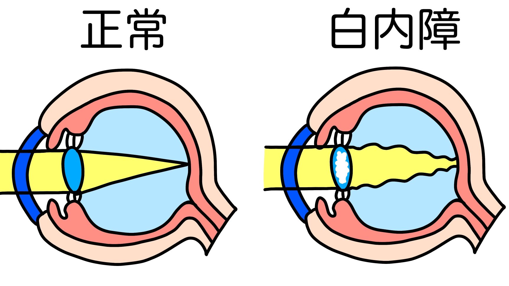 白内障イラスト