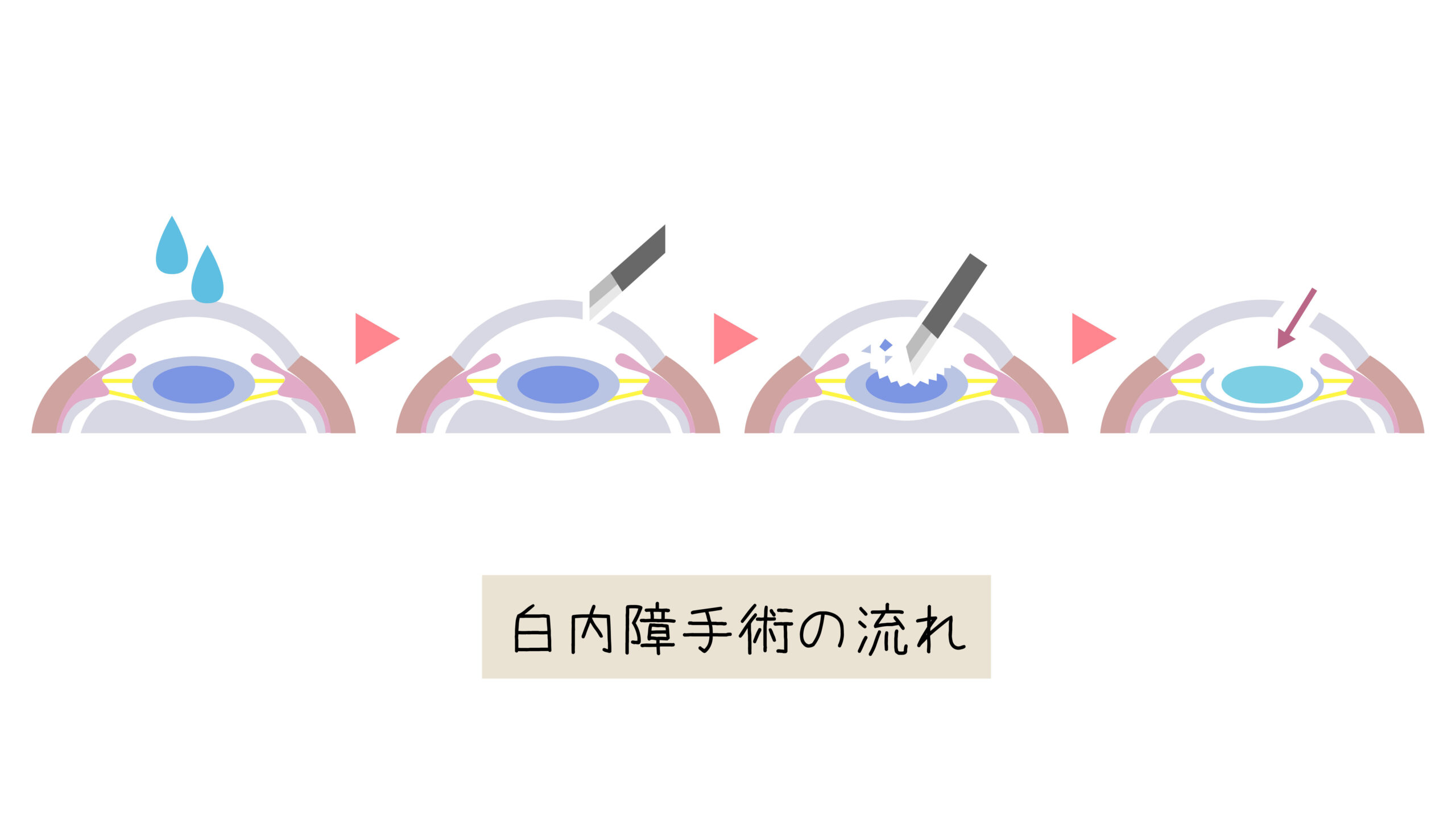 白内障手術の流れ