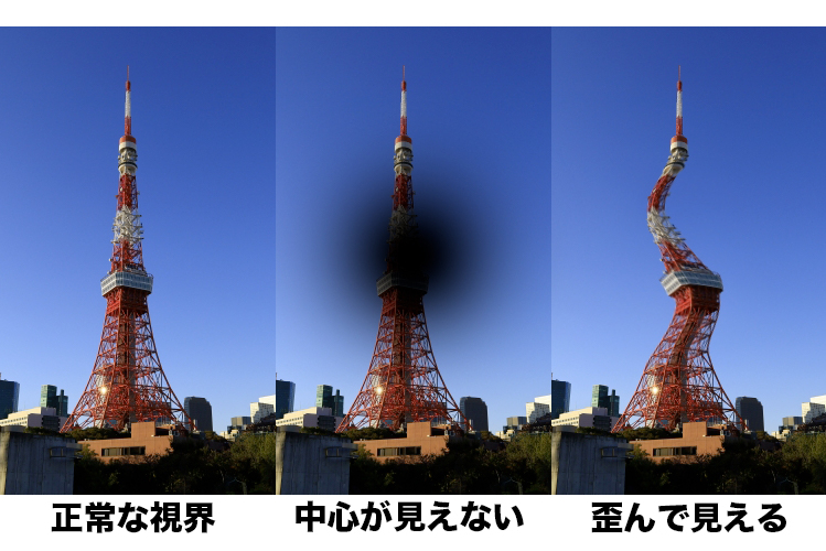 黄斑変性の見え方