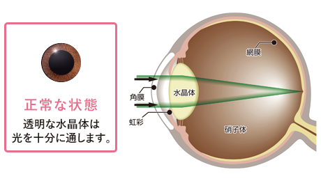 白内障手術について 北区王子駅前の眼科 白内障手術 王子さくら眼科 白内障手術について 北区王子駅前の眼科 白内障手術 王子さくら眼科