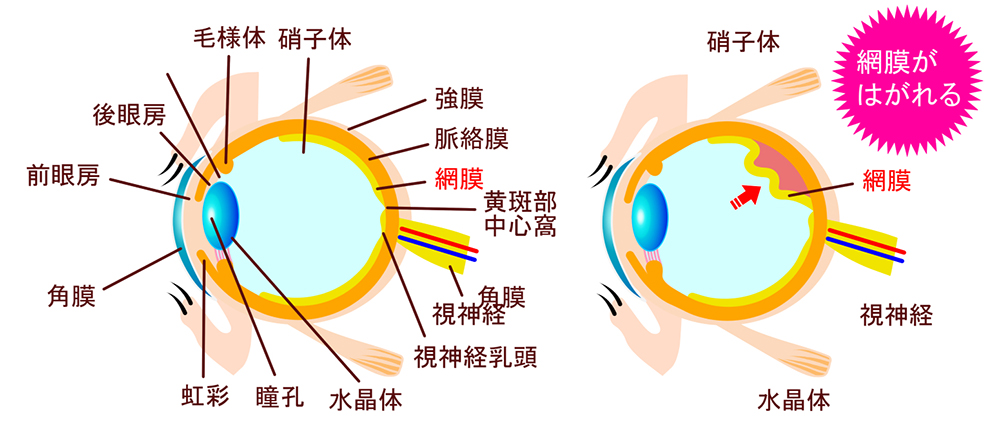 牽引性網膜剥離の治療