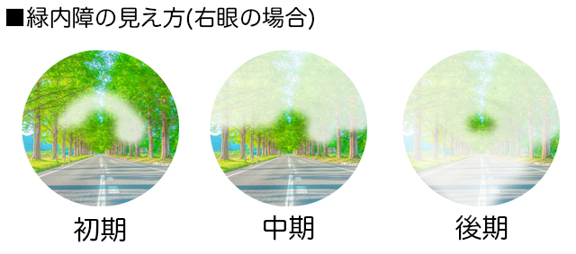 緑内障の見え方