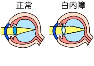白内障イラスト