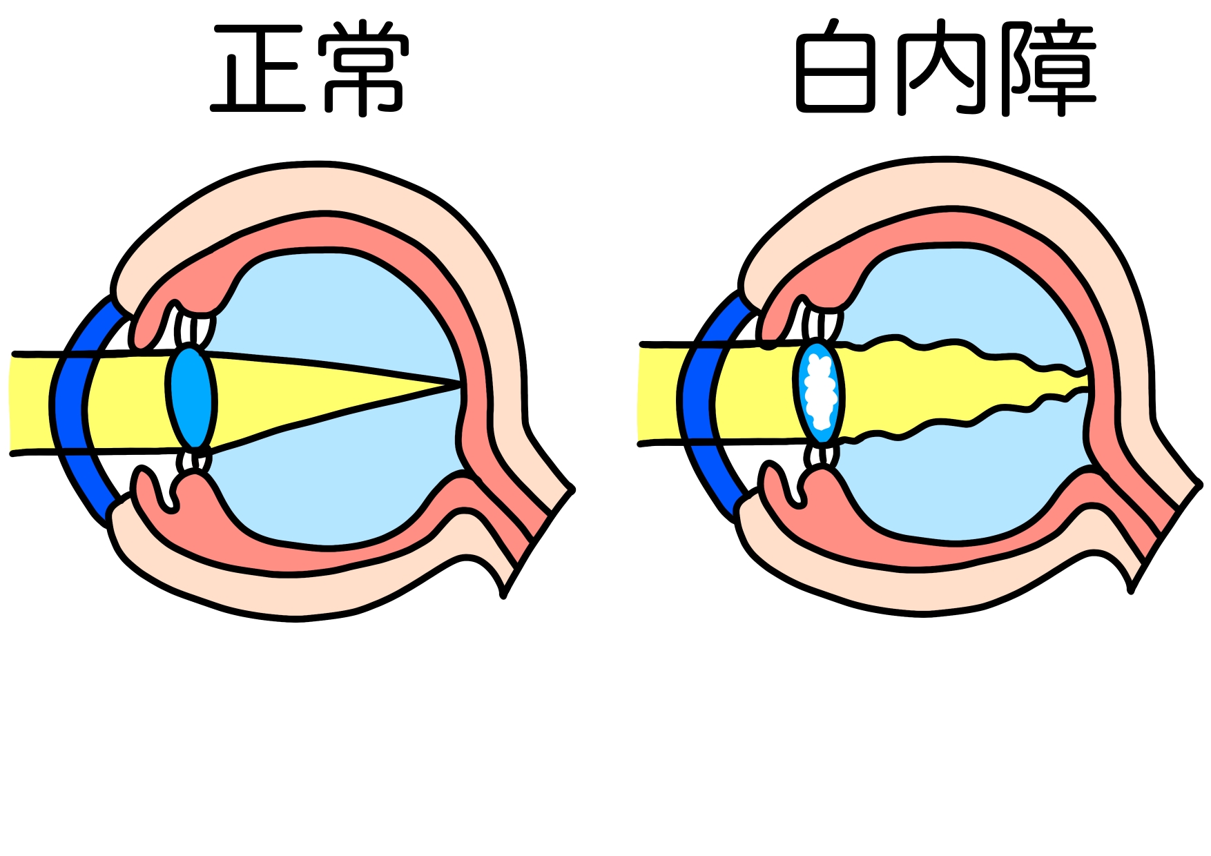 白内障イラスト