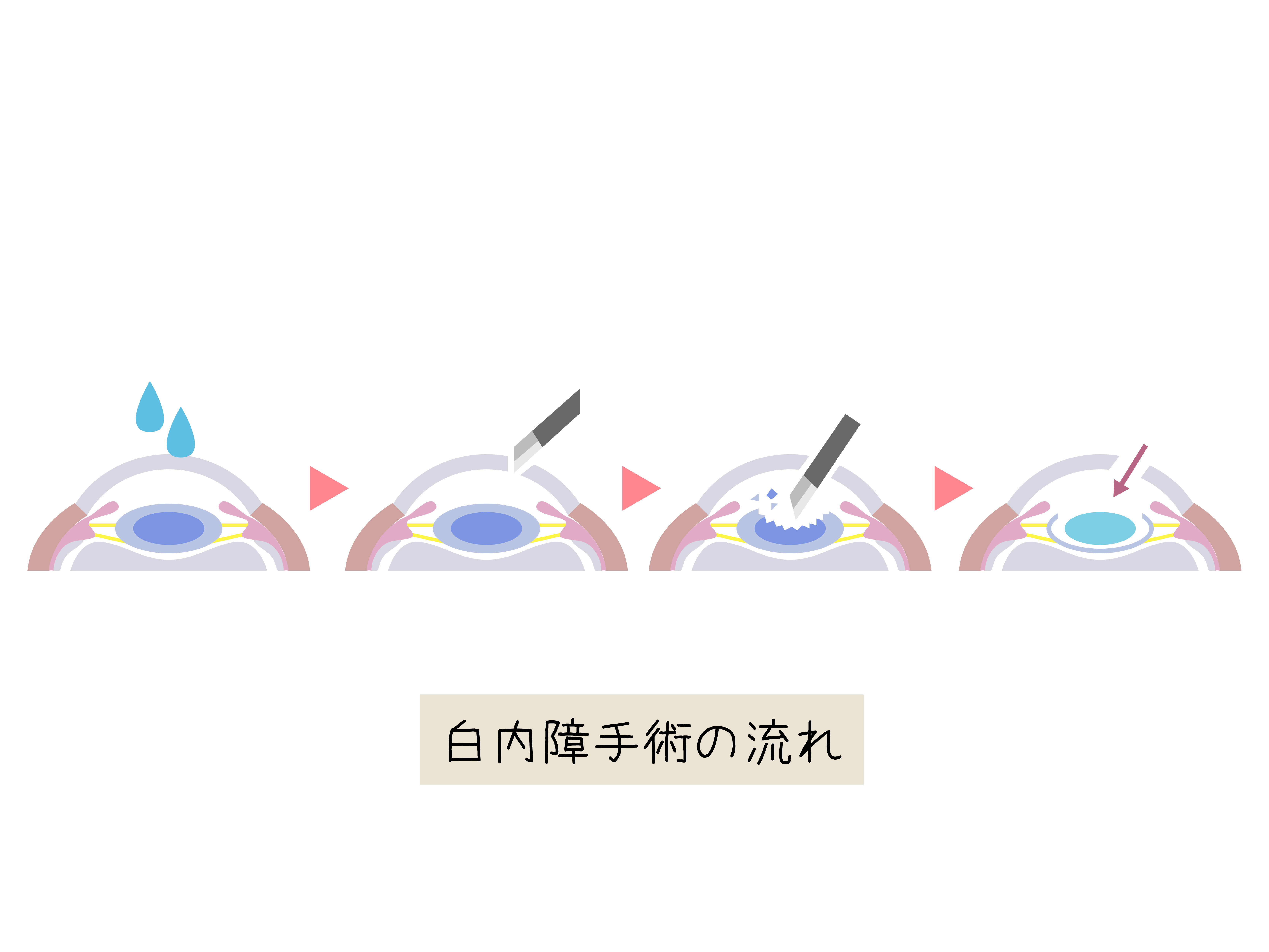 白内障手術の流れ